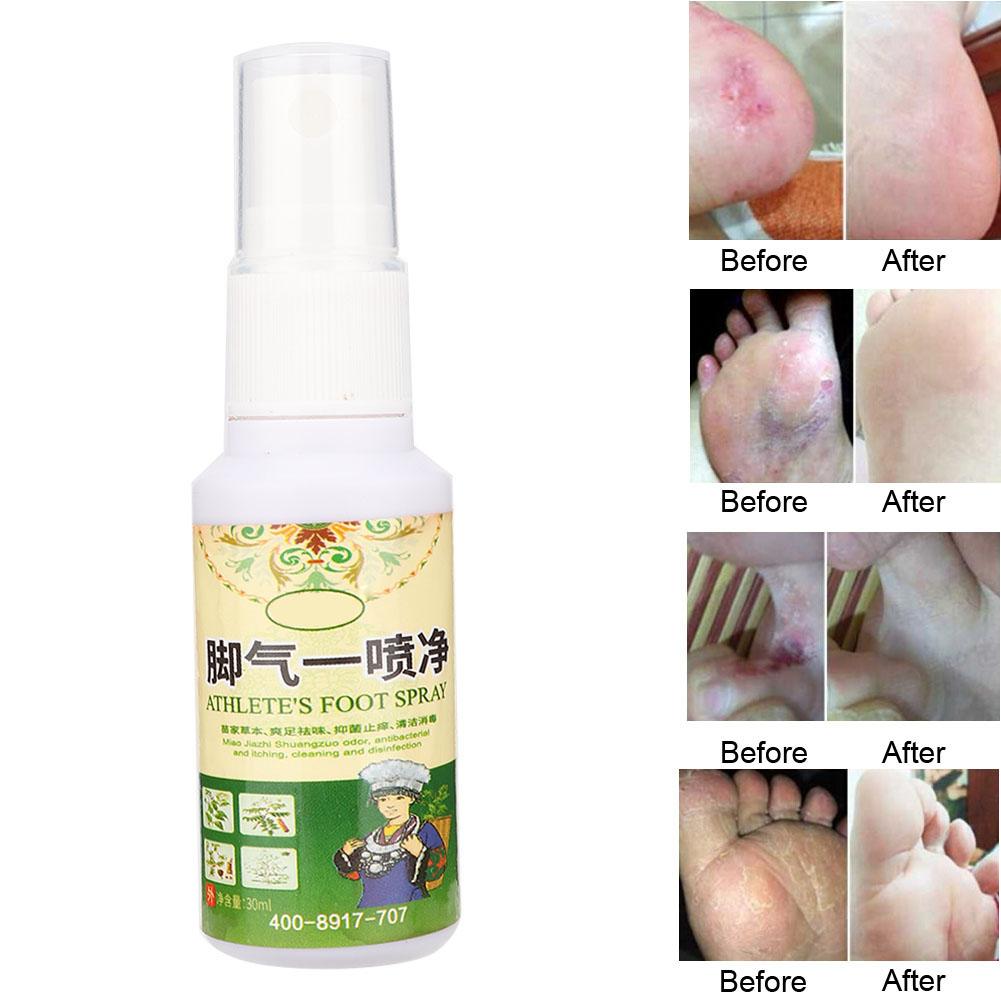 30ml Beriberi Removal Remove Foot Odor Sweat Antibacterial Bacteriostatic Plant Herb Spray