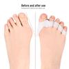 Silicone Bunion Corrector & Five-Hole Toe Separator for Overlapping Toes and Hallux Valgus