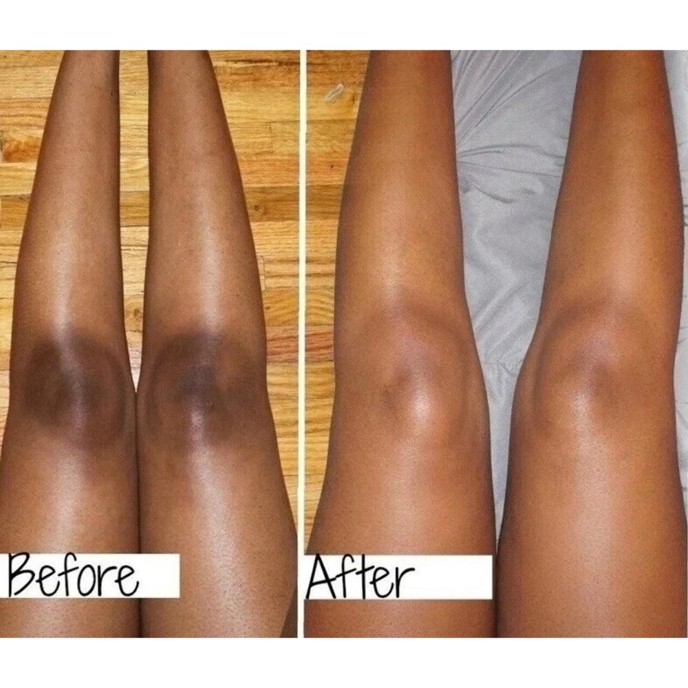 Dark Knuckle & Underarm Whitening Cream 50g | Body Moisturizer Lotion Dark Toe, Knuckles, Elbow, Inner Thigh, Neck Brightening