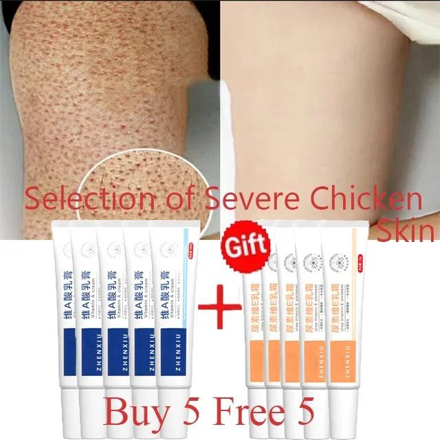 Body Whitening Cream Keratosis Pilaris Treatment Bumpy Rough Chicken Follicle Skin Repair Strawberry Legs Removal Dry Skin Care