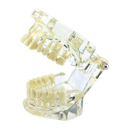 Dental Implant Model Teaching Aid for Dentist Student School Removable Teeth