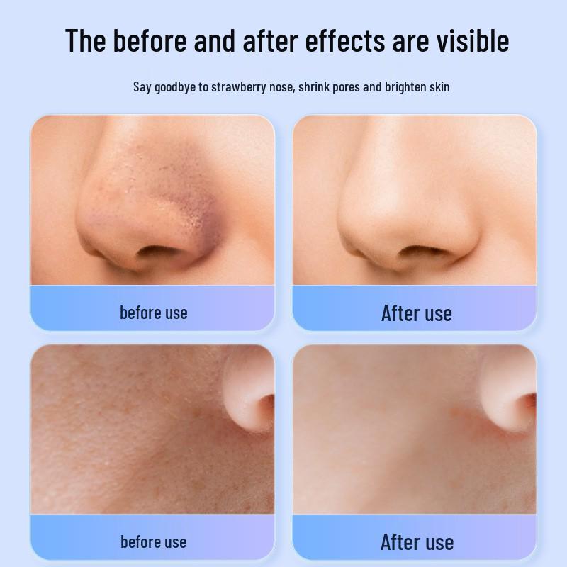 Limpiador de Poros Ultrasónico y Exfoliante Facial - Eliminador de Puntos Negros y Raspador de Piel