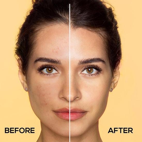RENEE 15% Vitamin C, 1% Salicylic & 2% Niacinamide Face Serum for Glowing Skin, Reduces Dark Spots, Acne, Fine Lines  for All Skin Type - 30 Ml