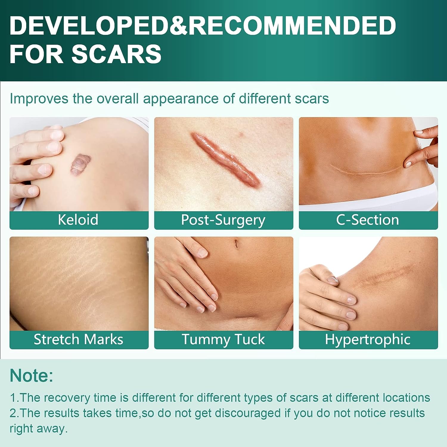 1 шт. 150 см силиконовый гелевый пластырь для лечения шрамов лента для удаления акне — фото 3