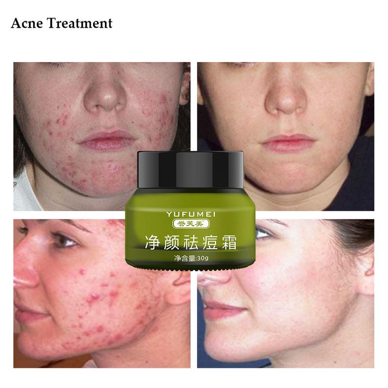 pimple pores removal cream