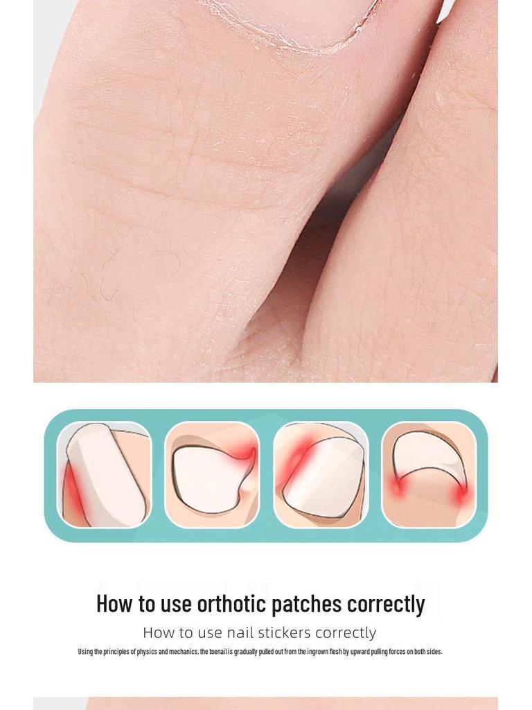 Nickel-Titanium Ingrown Toenail Corrector: Invisible, Wearable Nail Hook for Pain Relief