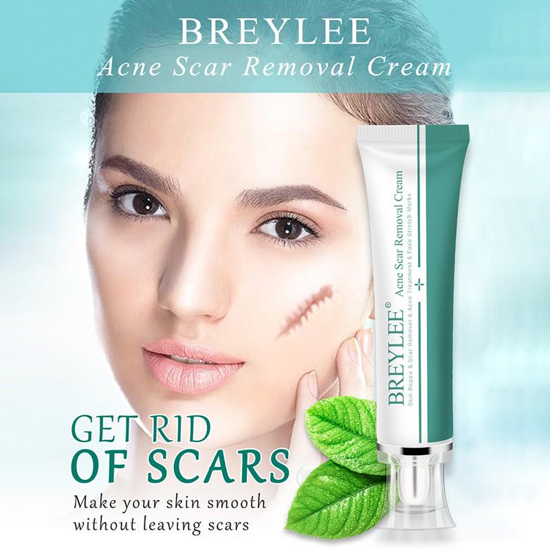 cream for face acne scars