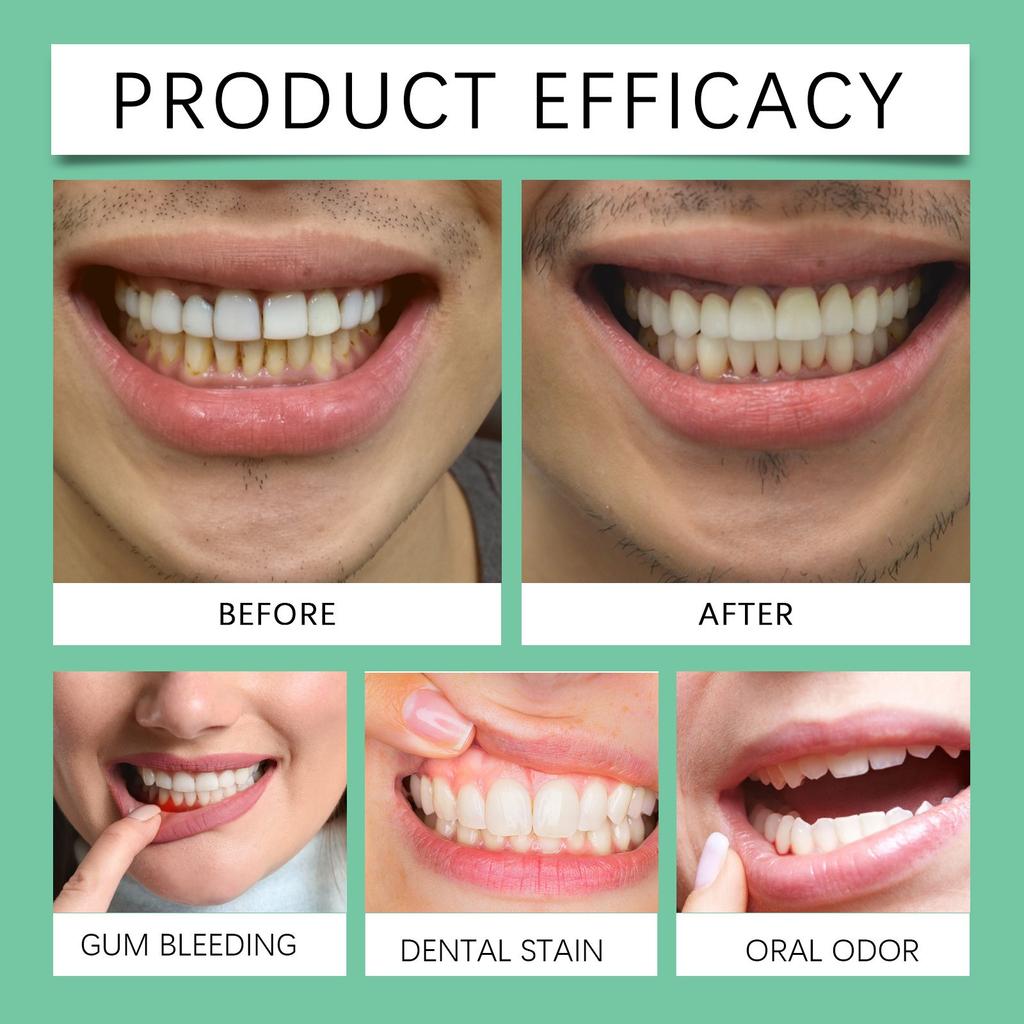 Tooth Care Gel, Tooth Gel, Oral Care Gel, Eliminates Swelling, Pain, Redness, Sensitivity, Teeth Whitening And Regeneration Gel 4ml