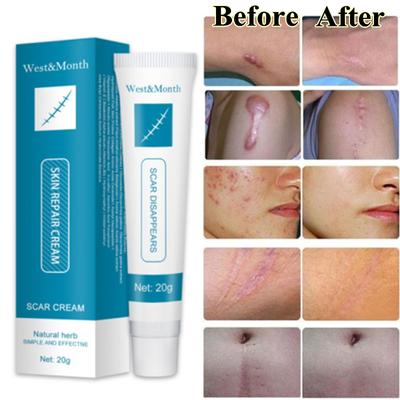Crema de eliminación de cicatrices a base de hierbas, Gel para estrías, elimina las manchas de acné, quemaduras, tratamiento de cicatrices quirúrgicas, blanqueamiento suave, cuidado de la piel del cuerpo y la cara