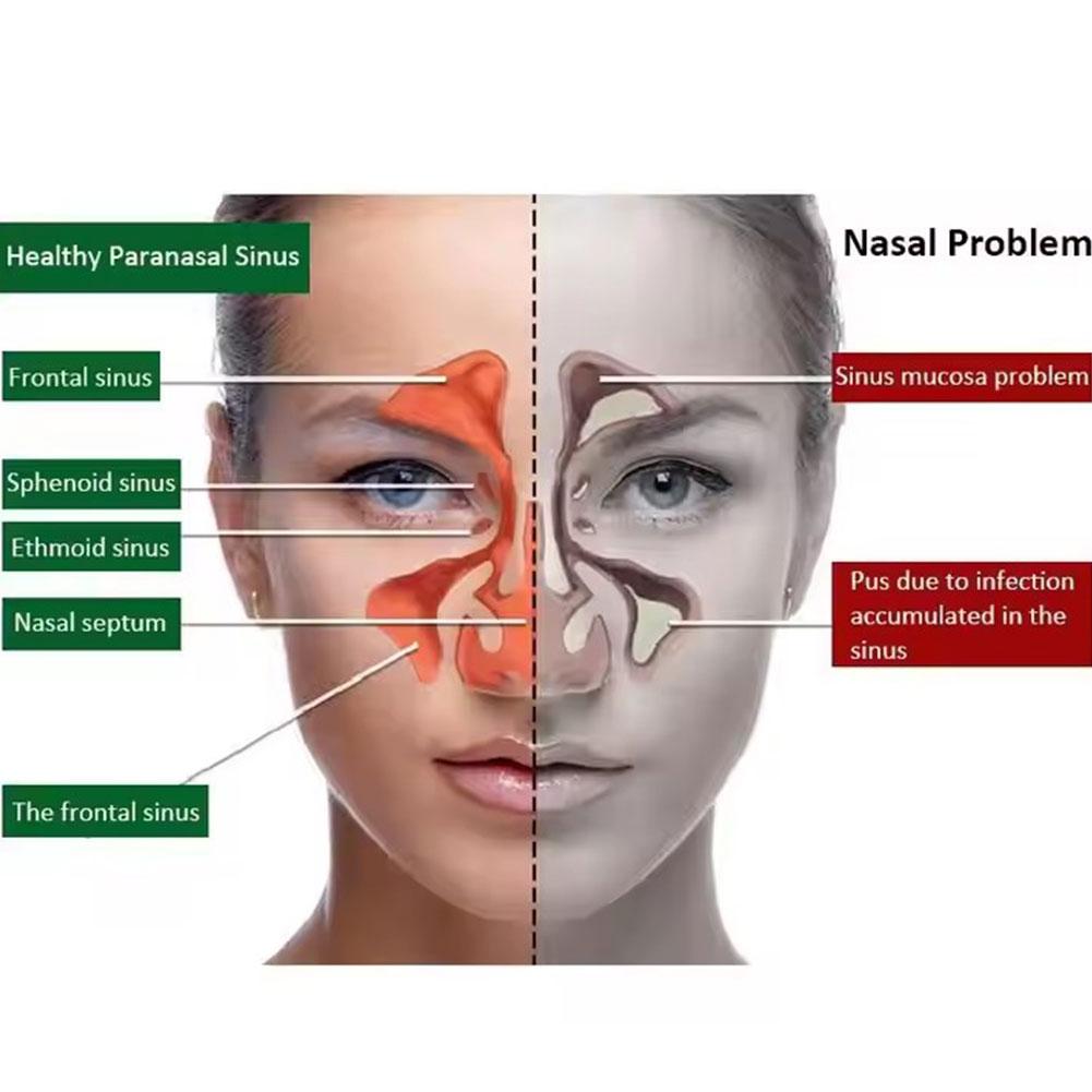 1*20ml Pure Natural Herbal Nose Spray for Rhinitis and Sinusitis Nasal Drops Make Your Nose More Comfortable Health Care