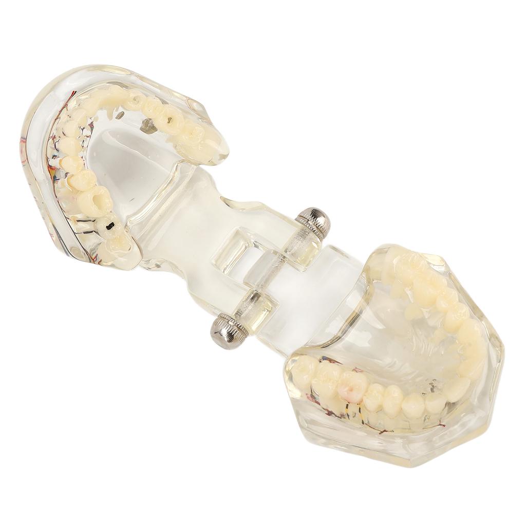 Transparent Dental Implant Pathological Model Implant Disease Teeth Model for Teaching Demonstration
