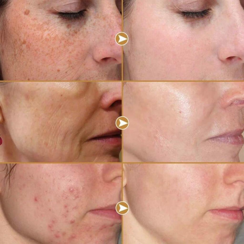 Whitening and Acne Removing essence Cream, brightening facial skin, anti-oxidation and anti-aging, moisturizing cream