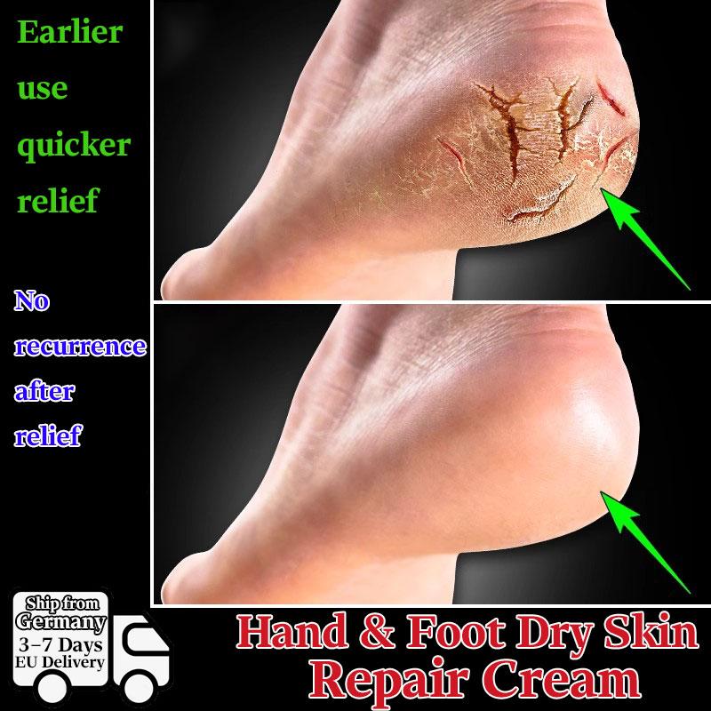 Natürliche Kräutercreme für trockene & rissige Hände & Füße - Sanft feuchtigkeitsspendend