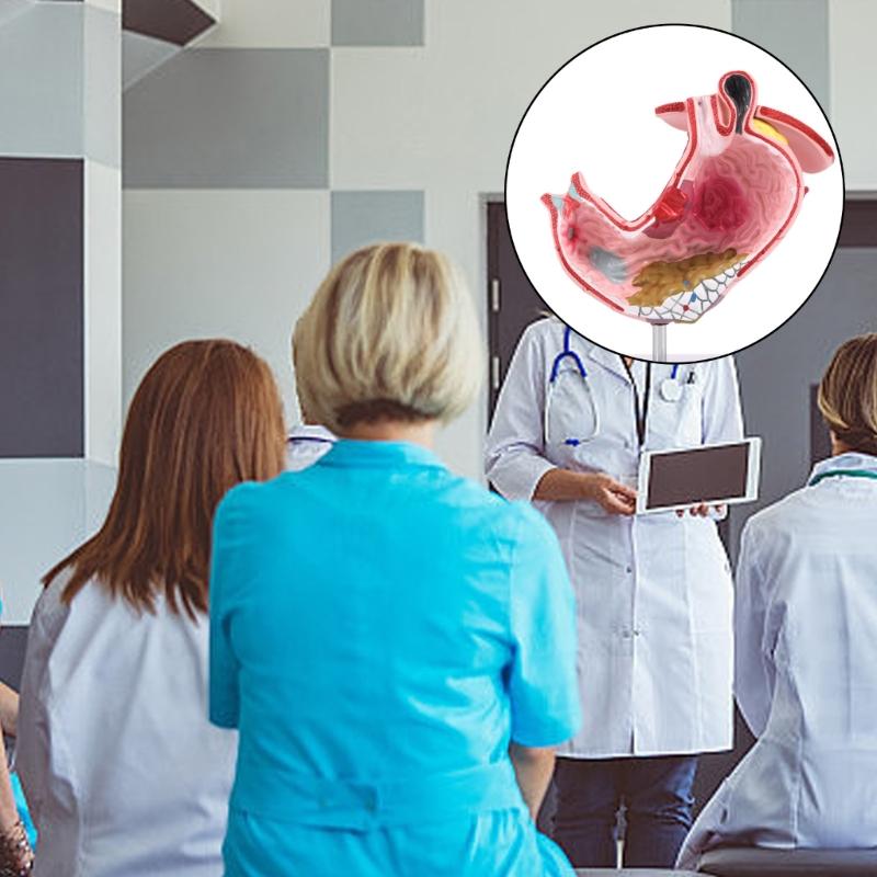 Diseased Stomach Model Stomach Anatomy Model Pathological Stomach Model For Medicals Students And Healthcare Learning