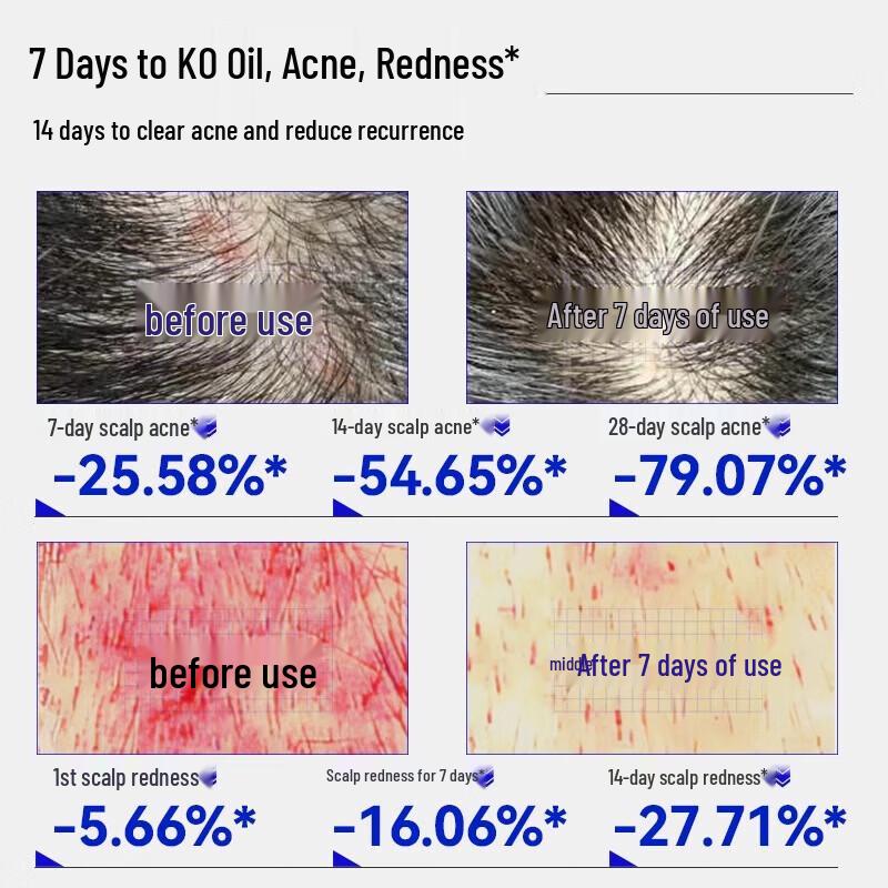 EHD Oil Control Anti-Acne Shampoo