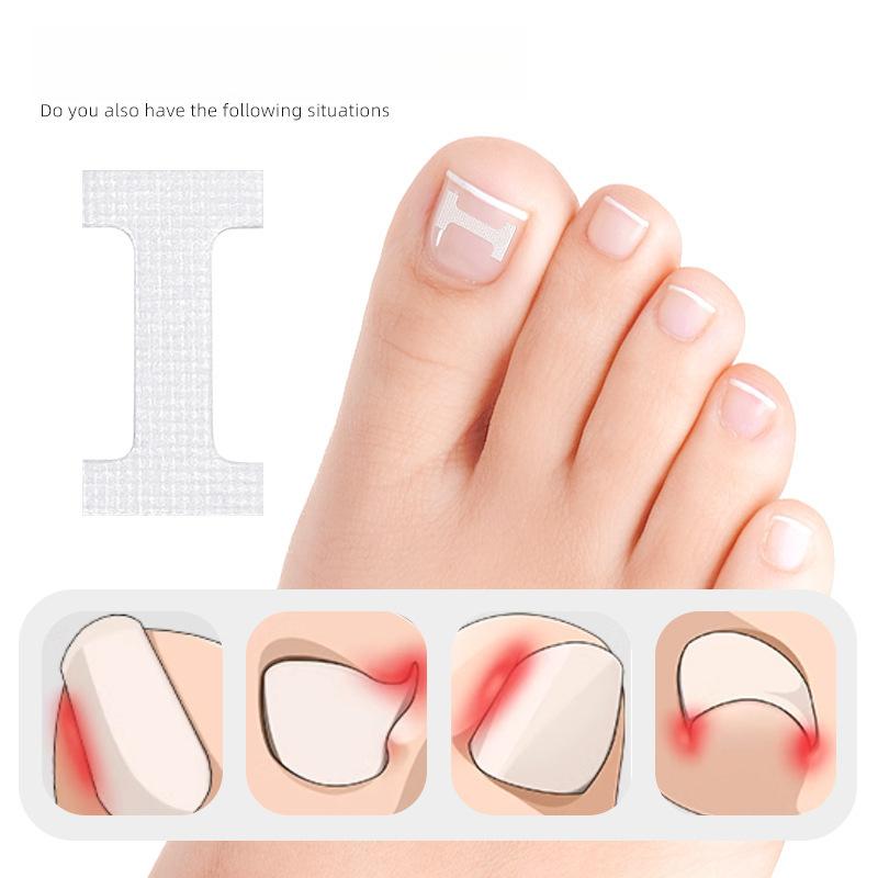 I-shaped Inlaid Nail Positive Nail Sticker Physical Stretching Patch Pull Nail Groove Curl Nail Small Invisible Shoes Can Walk