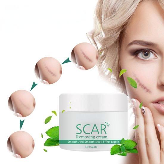 Natürliche Extrakt-Pflanzen-Akne-Stretch-Narben-Entfernungscremes für Sie