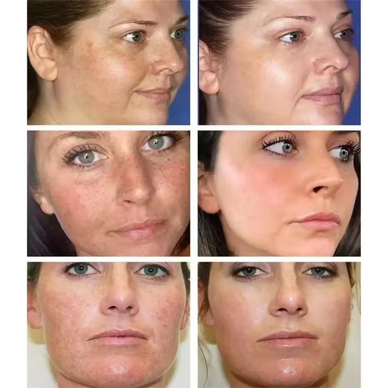 Freckle Whitening Cream Melasma Dark Spots Pigmentation Removal Product Fade Stain Melanin Fast Repair Brighten Korean Skin Car