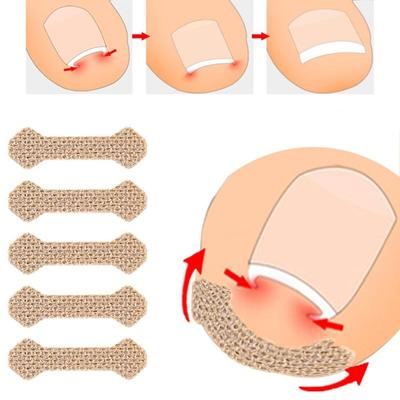 10 adet Batık Ayak Tırnaklarını Bant Yardımı Ağrı kesici Paronişi Düzeltme Pedikür Elastik Kuvvet Etiket Bandaj Ayak Tırnağı