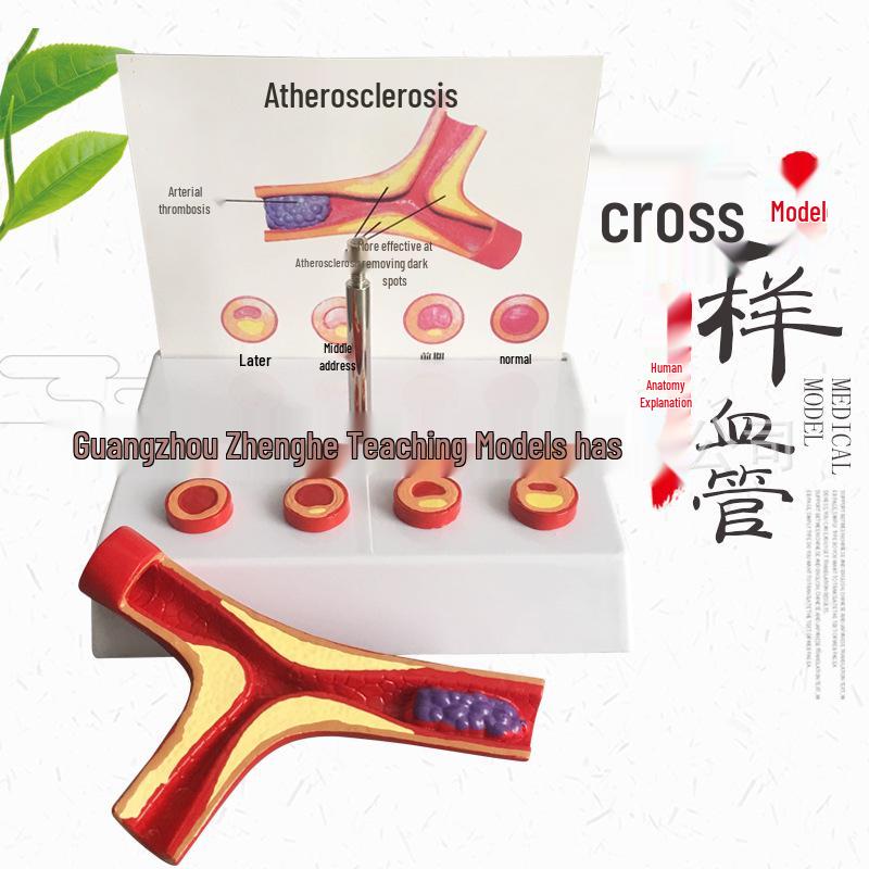 Atherosclerosis and Thrombosis Human Artery Model 18x14x16 cm