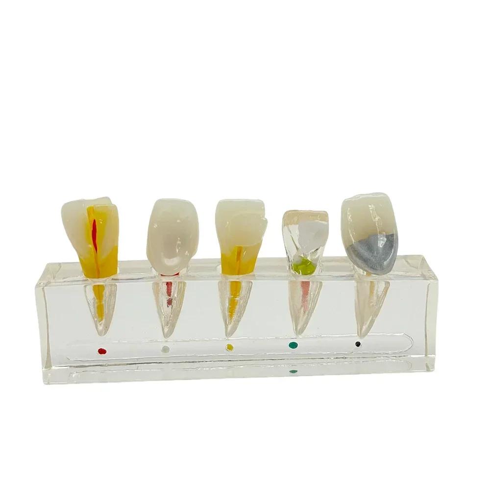 Dental Pulp Restoration Pathological Model Detachable Teeth Dissecting Premolar Teeth Cavity Filling Dentist Material