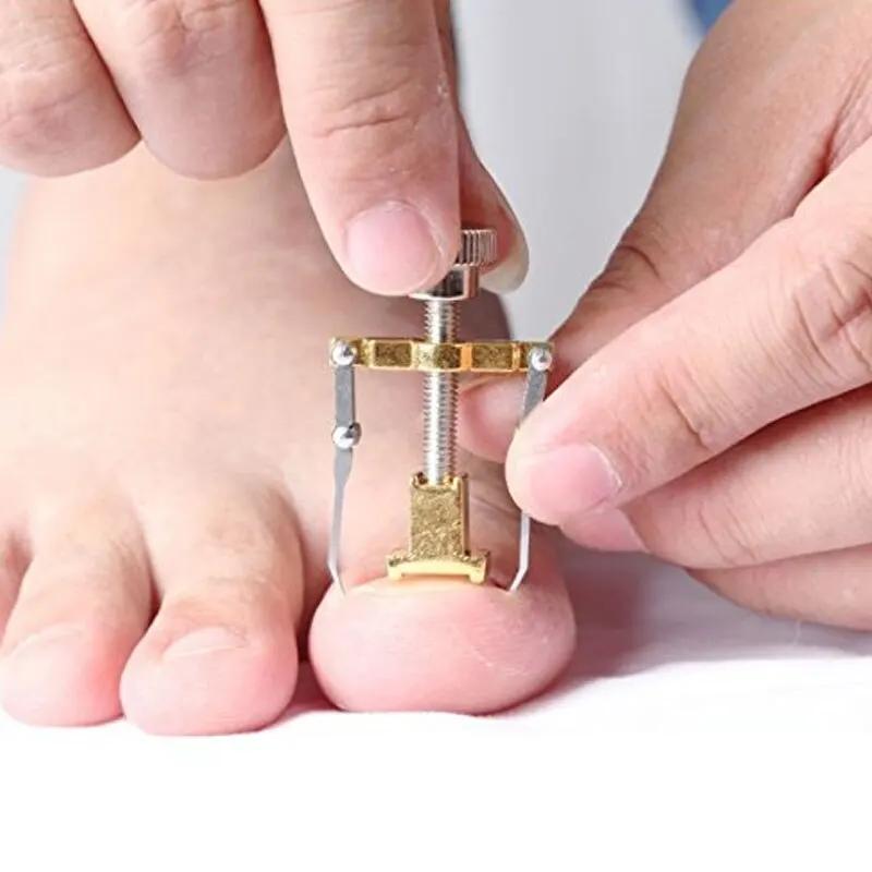 Correction of Paronychia with Toe Nail Correction Bracket for Treatment of Toe and Toe Care with Toe Fixator
