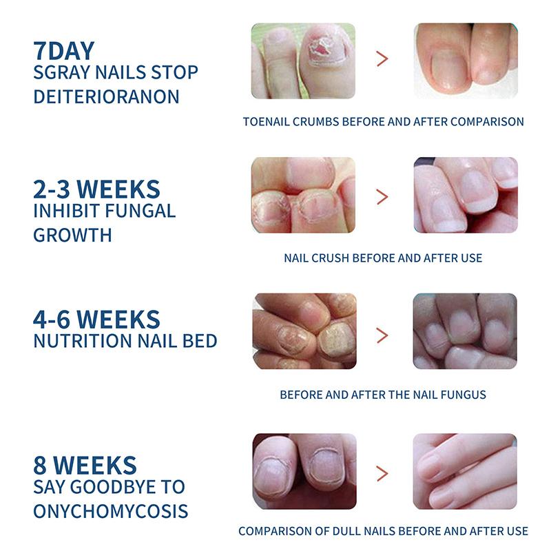 32Pcs  Safe Toenail Correction Patch Nail Repair Straightening Tool Sticker