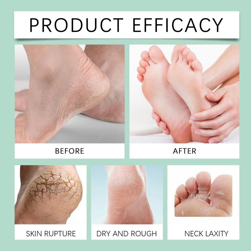 Foot And Exfoliating Spray Synergistically Softens, Moisturizes, Repairs, And Does Not Irritate Exfoliation 100ml