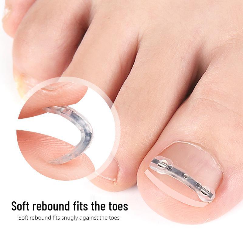 Double-Wing NiTi Alloy Bionic Bone Patch for Ingrown Toenail Correction (Invisible Physical Assistance Device).