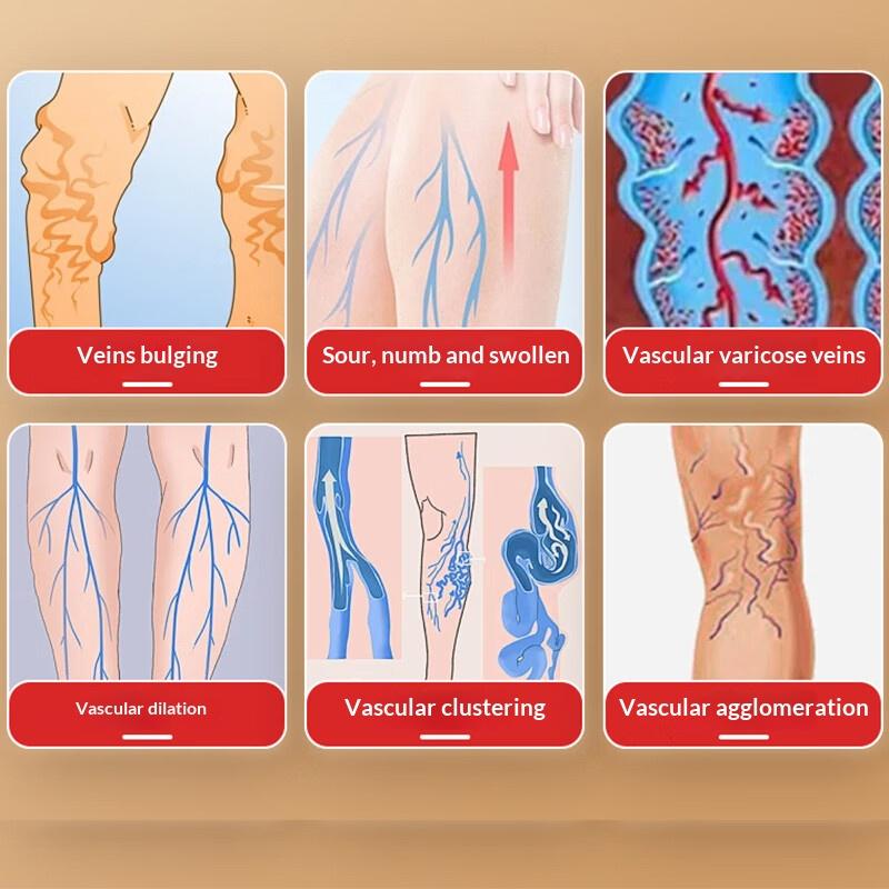 Thai Varicose Vein Cream: Relieves Leg Swelling & Improves Circulation – 55g