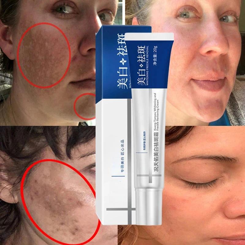Crème blanchissante efficace pour les taches de rousseur, élimine le mélasma, atténue les taches brunes, hydrate, éclaircit la peau du visage, produit de soin