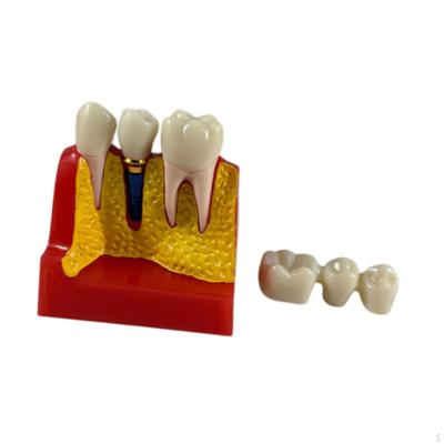 4 Times Tooth Model Teaching Model,Morphology Oral Hygiene Preventive Care,Tooth Display