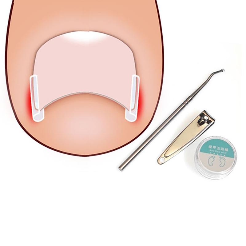 10 шт., инструмент для коррекции вросшего ногтя, лечение вросшего пальца, эластичная наклейка, выпрямляющий зажим, инструмент для педикюра one size