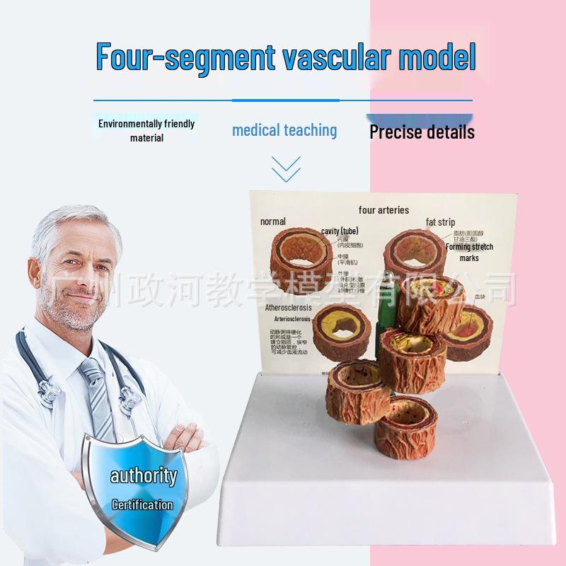 Thrombotic Vascular Model: Human Artery Atherosclerosis Simulation 17x14x5 cm