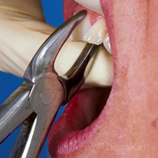 GDC Extraction Forceps Upper Anteriors - 1 Standard (FX1S)