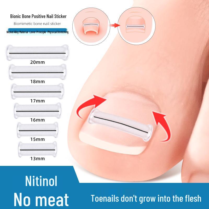 NiTi Alloy Bionic Toenail/Fingernail Corrector for Ingrown Nails