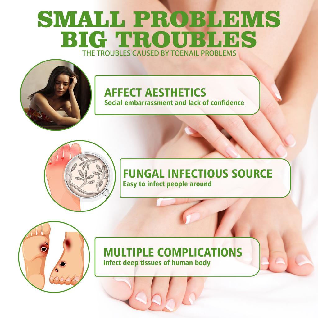 Toenail Fungus Care, FastActing Nail Care Liquid For Fungus Under & Around  Restores The Healthy Appearance Of Nails 30ml