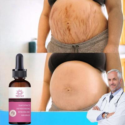 Potente olio essenziale per la rimozione delle smagliature, segni di gravidanza, rimozione delle cicatrici, maternità, pelle liscia, crema riparatrice per il corpo