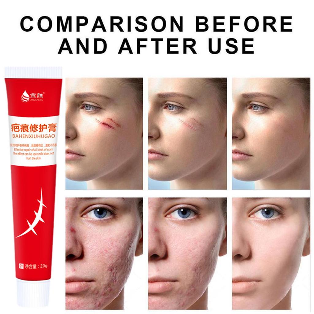 20 г крем для удаления шрамов от акне, хирургическое удаление растяжек, гель для кожи лица, отбеливающий пигментацию тела, Sm U4P9