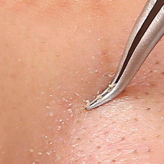 Edelstahl Pickel Akne Makel Komedonen Extraktor Mitesser Entferner Werkzeug