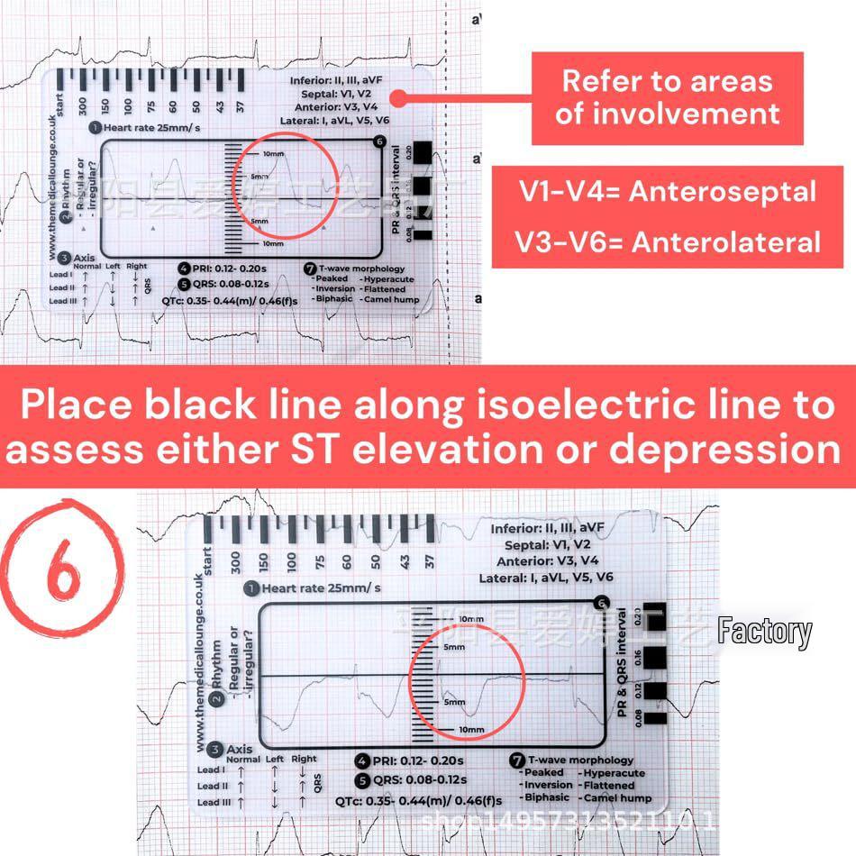 New Practical Portable ECG 7-Step Measuring Ruler