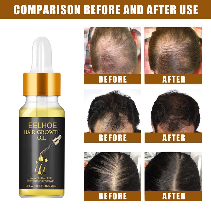 Fast Hair Growth Serum Hair Regrowth Essential Oil Anti Hair Loss Repair Damaged Scalp Women Men Anti Baldness Hair Growth Care
