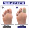 Gel Toe Spacers, Bunion Corrector with Loops(6PC), Portable Toe Separators for Women and Men for Bunion, Overlap Toe, Hammer Toe, Big Toe Alignment