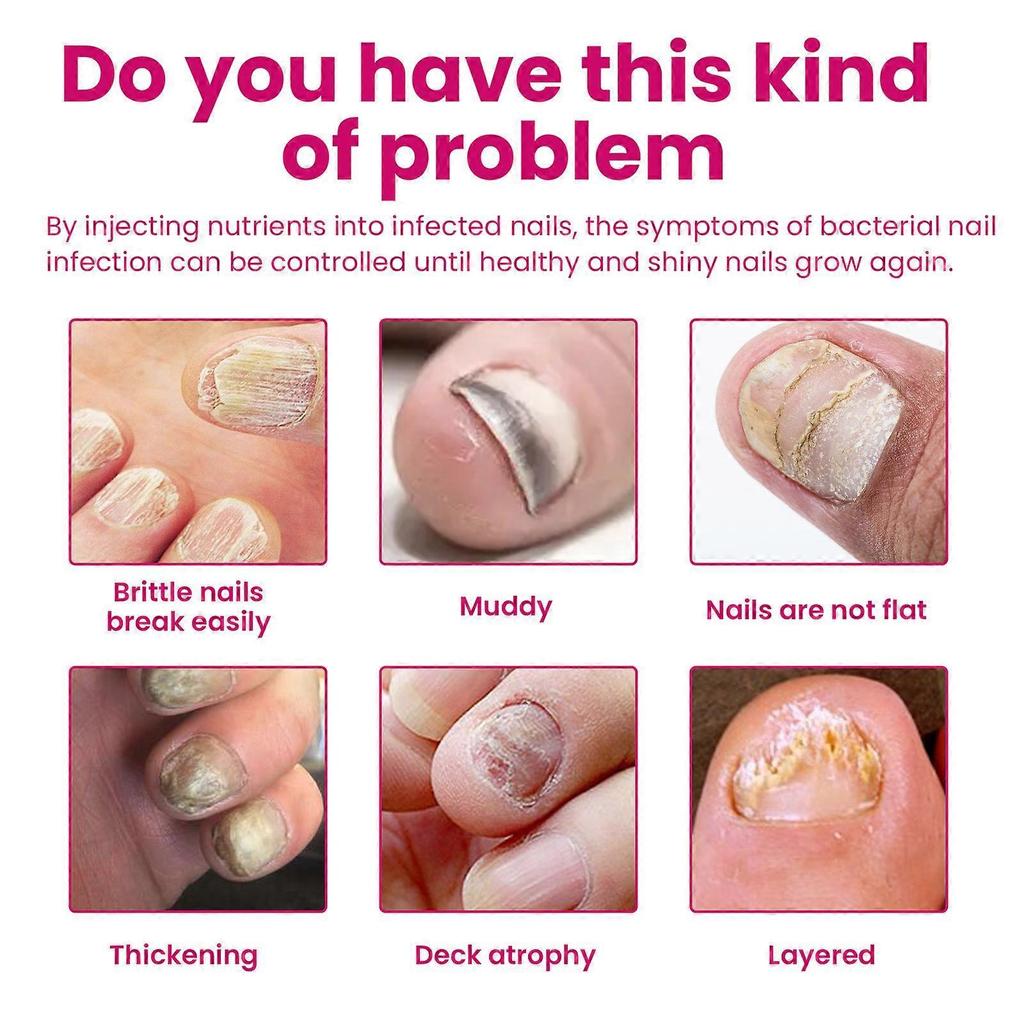 1-5x OUHOE Ingwer Nagelpflege Essenz, Graue Nägel Feuchtigkeitspflege Peeling Schönheitsnagel Essenz