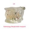 Dental Teaching Model Pathology Model With Half/Full Implant C1/C4 Dentist Laboratory Material Tools