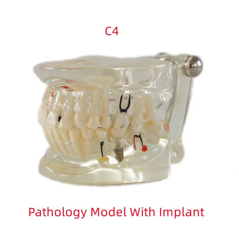 

Dental Teaching Model Pathology Model With Half/Full Implant C1/C4 Dentist Laboratory Material Tools
