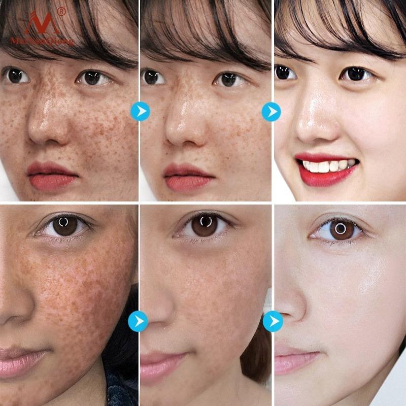 Newest Whitening Facial Cream Repair Fade Freckles Remove Dark Spots Melanin Remover Brightening Face Freckle Cream