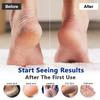 Urea Foot Cream Heel Dead Skin Removal Moisturizing Treatment Cream For Dry Cracked Feet Knees Hand Skin Care Beauty Health