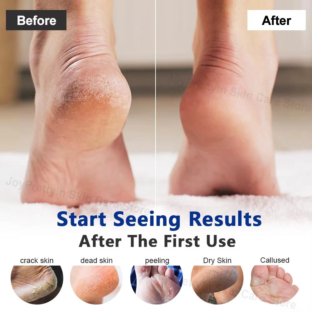 Urea Foot Cream Heel Dead Skin Removal Moisturizing Treatment Cream For Dry Cracked Feet Knees Hand Skin Care Beauty Health