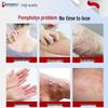 Chuan Nian Pompholyx & Eczema Relief Ointment